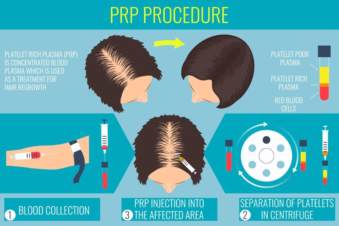 Prp For Hair Loss Surgeon In Bangalore Book Appointment Online