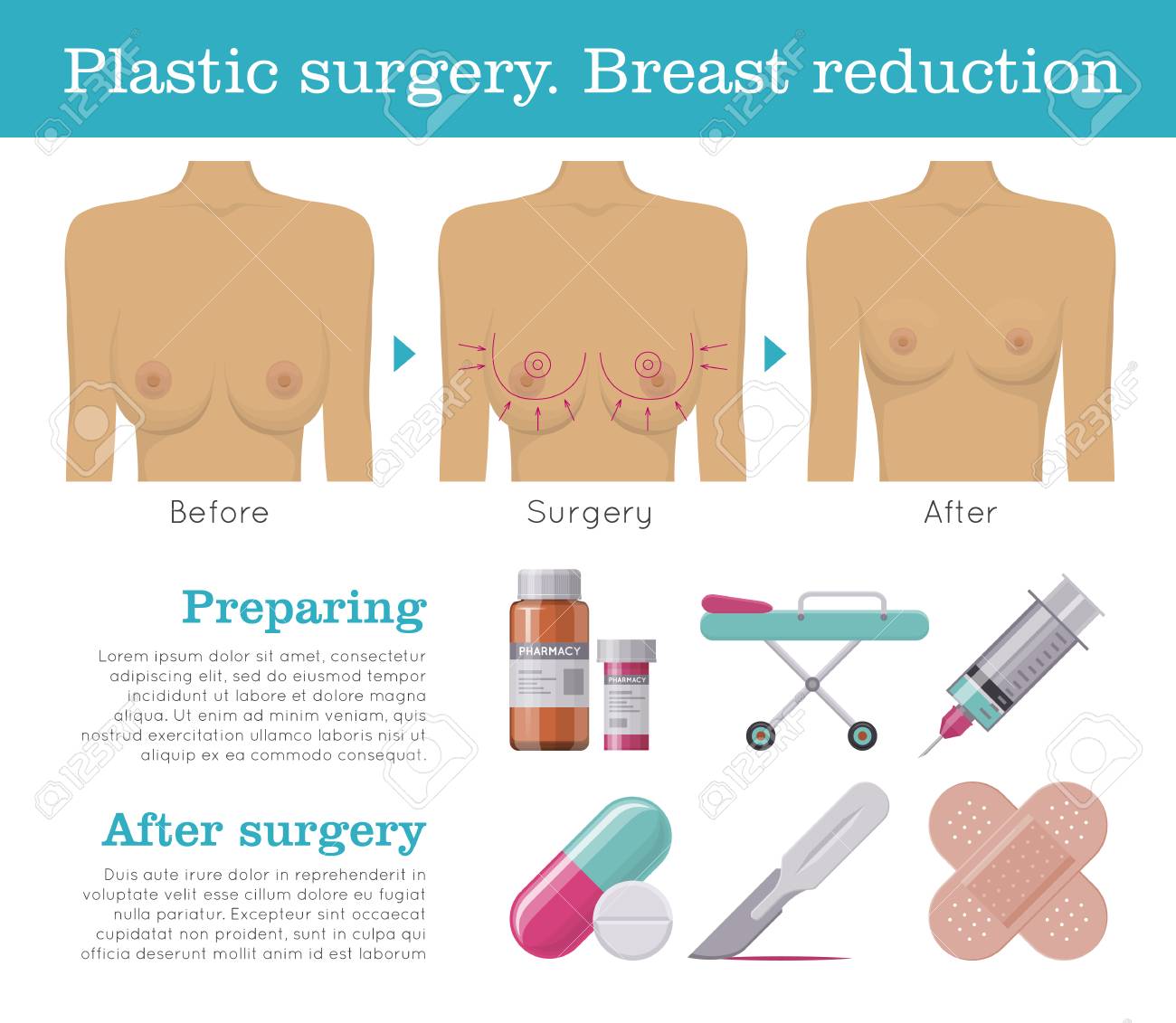 Breast Reduction Surgery - Medcontour Book Now