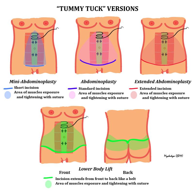 Tummy Tuck in Kano - MedContour - Find Best Surgeon
