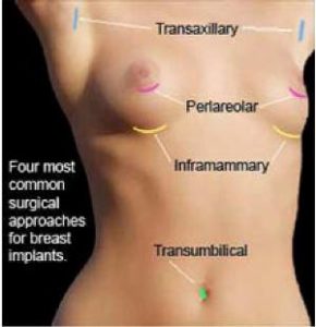 Breast Implant Cost in Kolkata MedContour