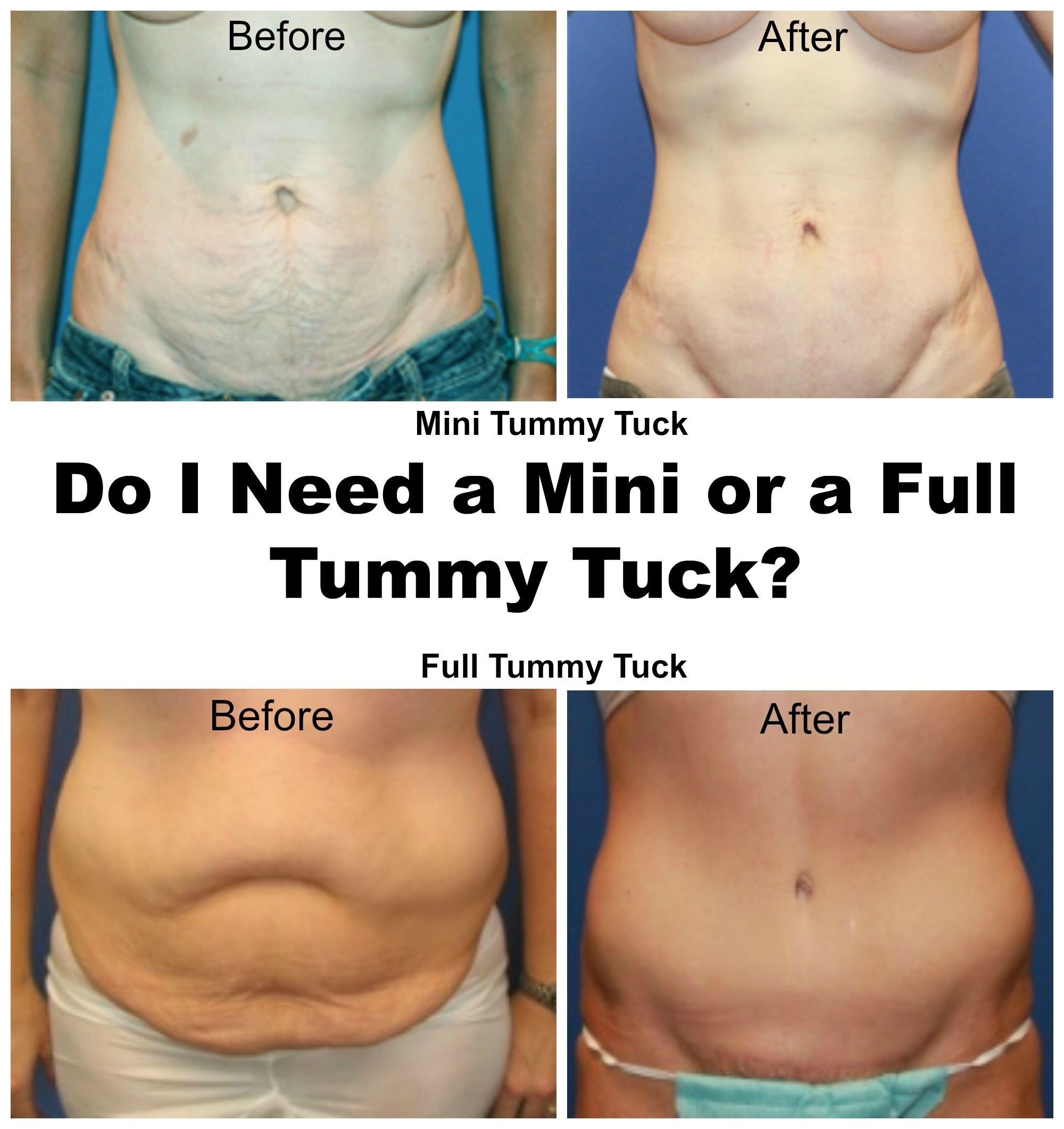 Tummy Tuck Cost in Bangalore - Compare Prices, Reviews, Best Doctors & ...
