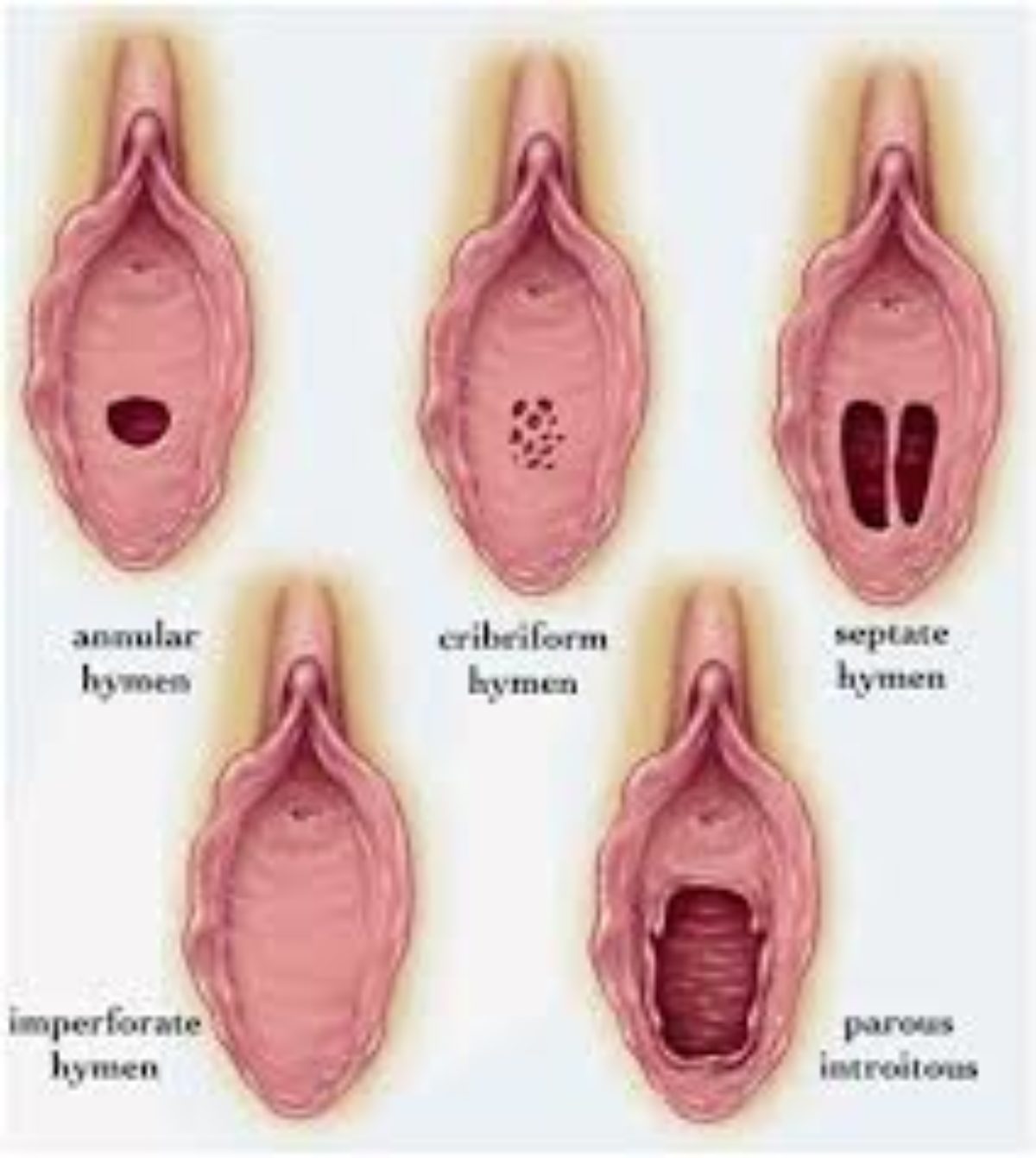 Hymenoplasty Surgery Cost In Bangladesh Find Reviews And Doctors Medcontour