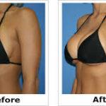 Breast Implant Revision in Bangalore