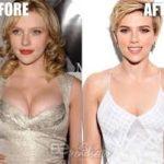 Breast Reduction in Bangalore