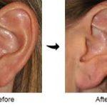 Ear Lobe Surgeon in Bengaluru