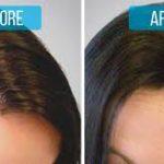 Hair Loss Treatment Specialist in Bangalore
