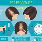 PRP for Hair Loss Surgeon In Bangalore