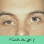 Ptosis Specialist In Bangalore