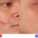 Scar Removal Surgeon In Bangalore