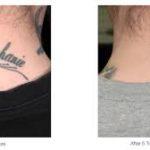 Tattoo Removal Surgeon In Bangalore