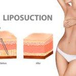Tumescent Liposuction