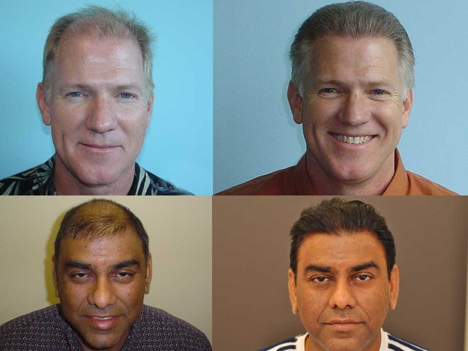 Hair Transplant Banner Archives Medcontour