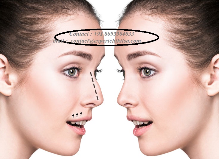 Best Rhinoplasty Surgeons in Bangalore Find Cost Estimate, Reviews, Before and After Photos