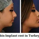 Chin Implant cost in Turkey 