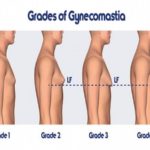 Gynecomastia cost in Turkey