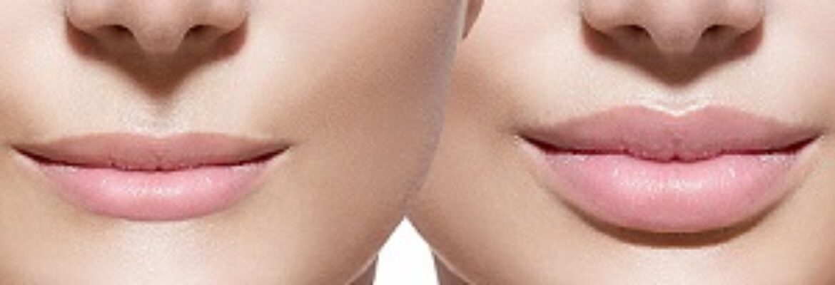 Best Lip Lift Surgeons in Turkey – Find Cost Estimate, Reviews, Before and After Photos and Book Appointment