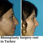 Rhinoplasty Surgery cost in Turkey