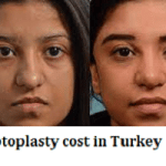 Septoplasty cost in Turkey