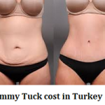 Tummy Tuck cost in Turkey
