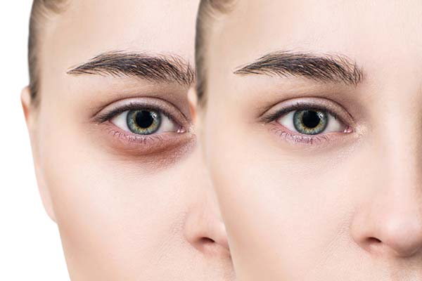 Dark Circles Removal under Eyes in Dhaka - Find Cost Estimate, Best  Dermatologists, Reviews and Book Appointment - MedContour