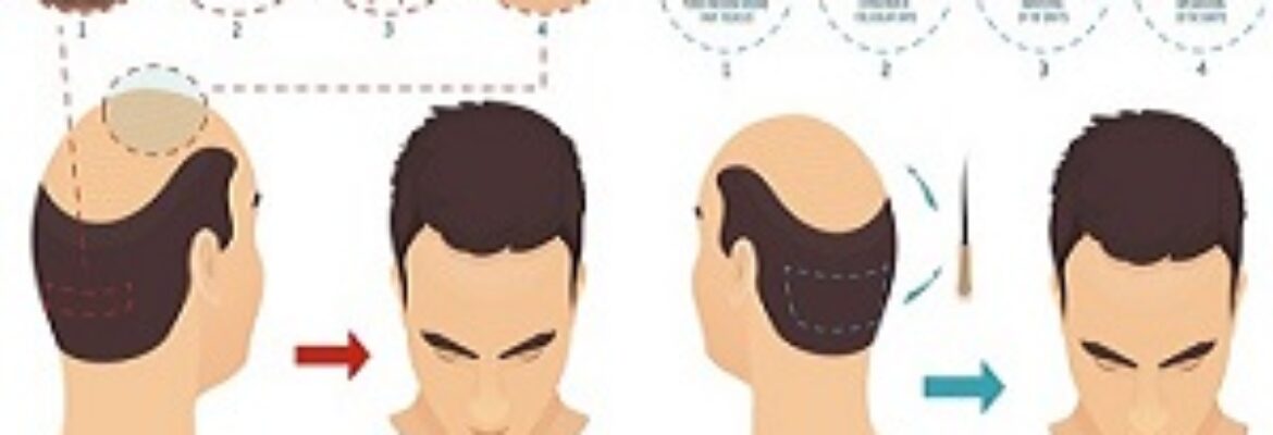 Hair Transplant in Dhaka - Find Cost Estimate, Reviews, Best Dermatologists  and Book Appointment - MedContour