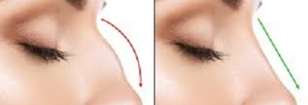 Best Rhinoplasty Surgeons in Gopalapuram, Chennai – Find Cost Estimate, Reviews and After Photos