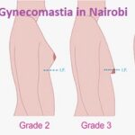 Gynecomastia Cost in Nairobi