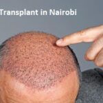 Hair Transplant in Nairobi