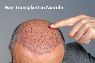 Hair Transplant Cost in Nairobi - Find The Best Surgeon and Reviews -  MedContour