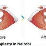 Hymenoplasty cost in Nairobi