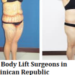 Best Body Lift Surgeons in Dominican Republic