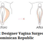 Best Designer Vagina Surgeons in Dominican Republic