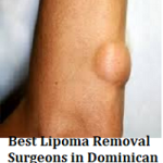 Best Lipoma Removal Surgeons in Dominican Republic