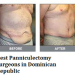 Best Panniculectomy Surgeons in Dominican Republic