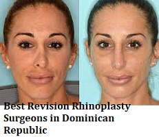 Best Revision Rhinoplasty Surgeons in Dominican Republic - Find Cost and Reviews. - MedContour