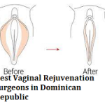 Best Vaginal Rejuvenation Surgeons in Dominican Republic