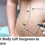 Best Body Lift Surgeons in Mexico