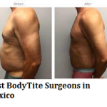 Best BodyTite Surgeons in Mexico