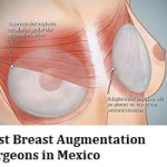Best Breast Augmentation Surgeons in Mexico