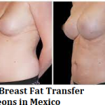 Best Breast Fat Transfer Surgeons in Mexico