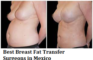Breast Implants Mexico: Are Breast Implants #1 Quality?