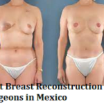 Best Breast Reconstruction Surgeons in Mexico