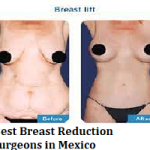 Best Breast Reduction Surgeons in Mexico