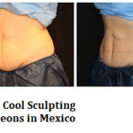 Best Cool Sculpting Surgeons in Mexico