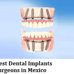 Best Dental Implants Surgeons in Mexico