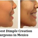 Best Dimple Creation Surgeons in Mexico