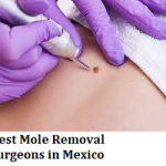 Best Mole Removal Surgeons in Mexico