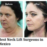 Best Neck Lift Surgeons in Mexico