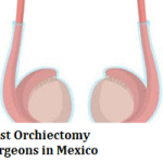 Best Orchiectomy Surgeons in Mexico