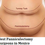 Best Panniculectomy Surgeons in Mexico